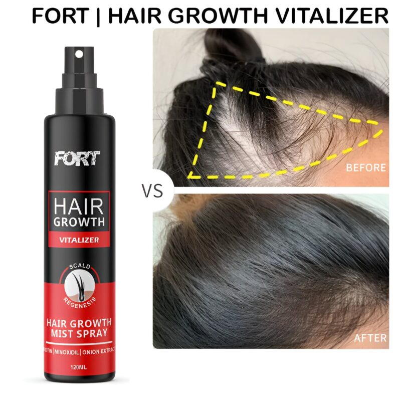 FORT Minoxidil Hair Growth Spray (120ml)